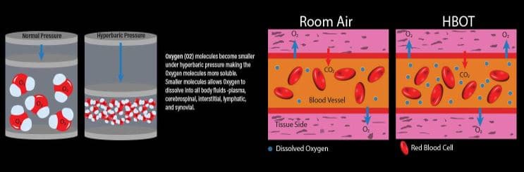 Chiropractic Lubbock TX Hyperbaric Therapy